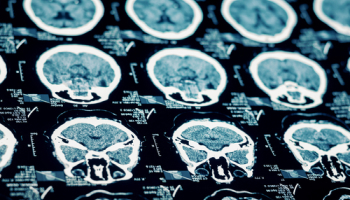 Brain scan